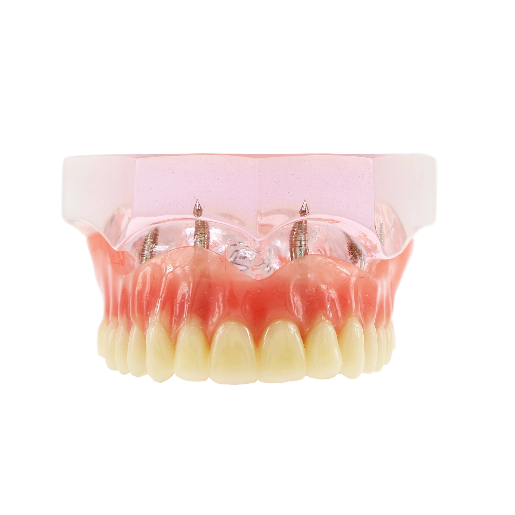 Dentistry Teeth Model With Clear Upper 4 Implants Overdenture Restoration Model For Dentist Explain Overdenture Functioning