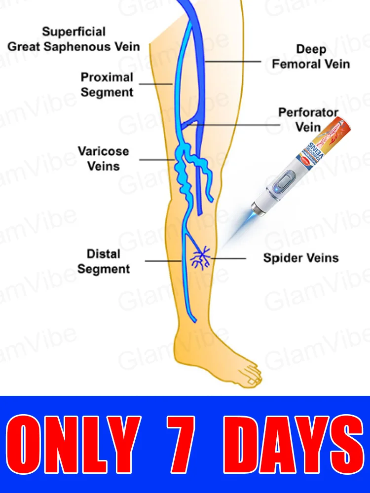 

blue light pen solve varicose veins, hot sale leg care tools
