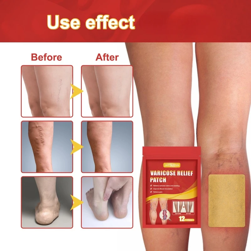 Varicose Veins Patch Relief Leg Vasculitis Spider Varicose Vein Patches Varicose Veins For Legs Improve Blood Foot Health Care