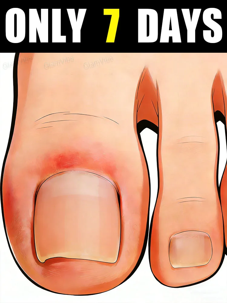 

ᴺᵃⁱˡ ᶠᵘⁿᵍᵘˢ ᵗʳᵉᵃᵗᵐᵉⁿᵗ!Say Goodbye to Yellow Dullness