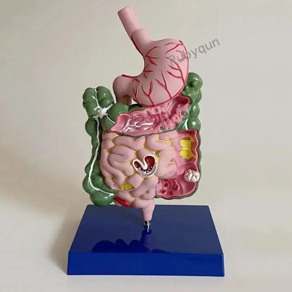 Human Digestive System Model Stomach Esophagus Stoh Large Small Intestine Ileum Medical Commation Pathological Colon Hemorrhoi