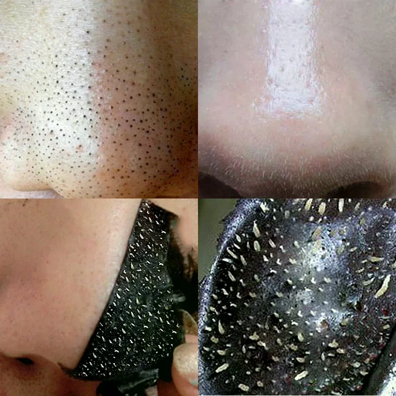 /ACR/Nose Blackhead Remover Mask Deep Cleaning Shrink Pore Treatment Mask 10PCS