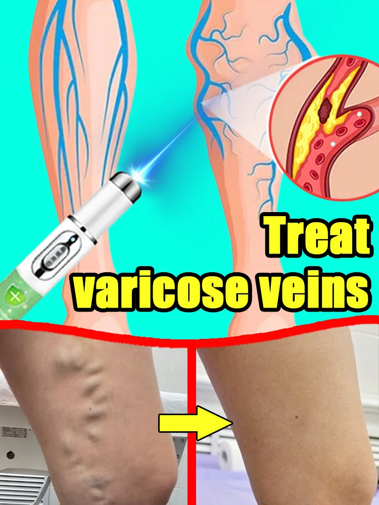 

Quickly remove varicose veins without recurrence
