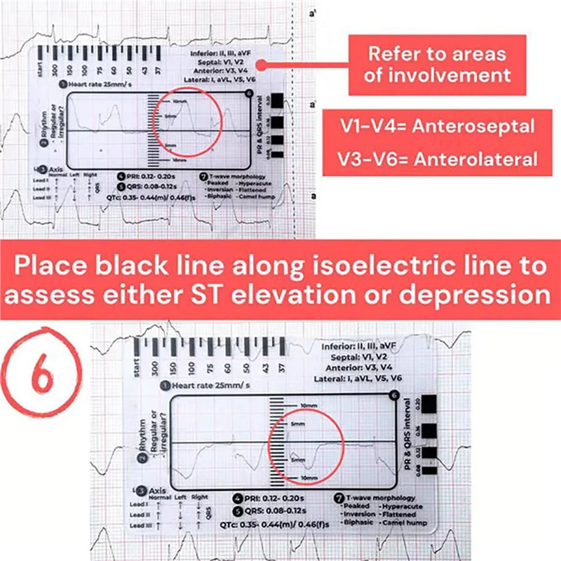 

AB13-4PCS 7-ступенчатая линейка ЭКГ, 7-ступенчатая линейка ЭКГ для тердавления ЭКГ/ЭКГ, линейка ЭКГ, портативный инструмент для оценки ЭКГ-карта