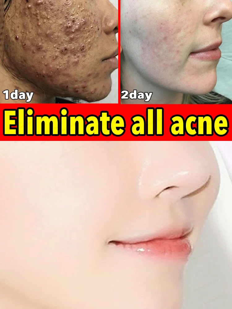 

remove acne scars face marks remedy pimple remedy