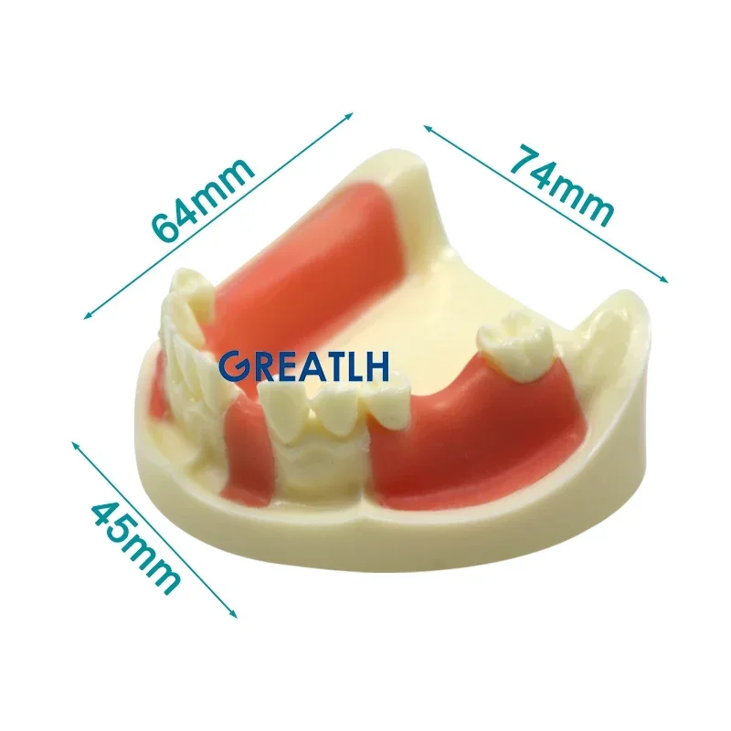 GREATLH Dental Lower Jaw Implant Practice Model Gingiva with Missing Teeth Dentist Educational Dental Teeth Practise Model