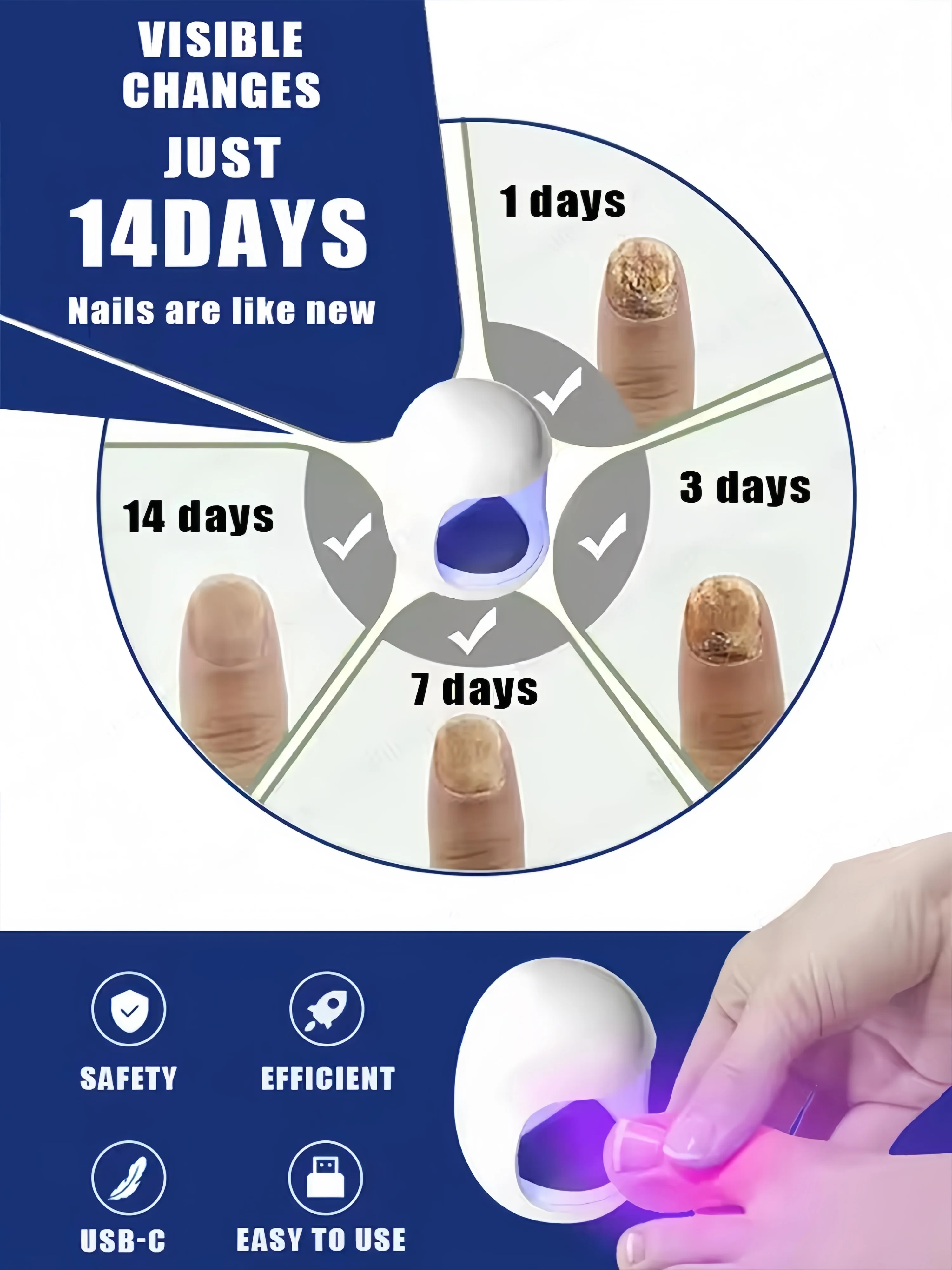 ينتج الليزر لور الحرق، إعادة تشكيل المشاكل d'ongles