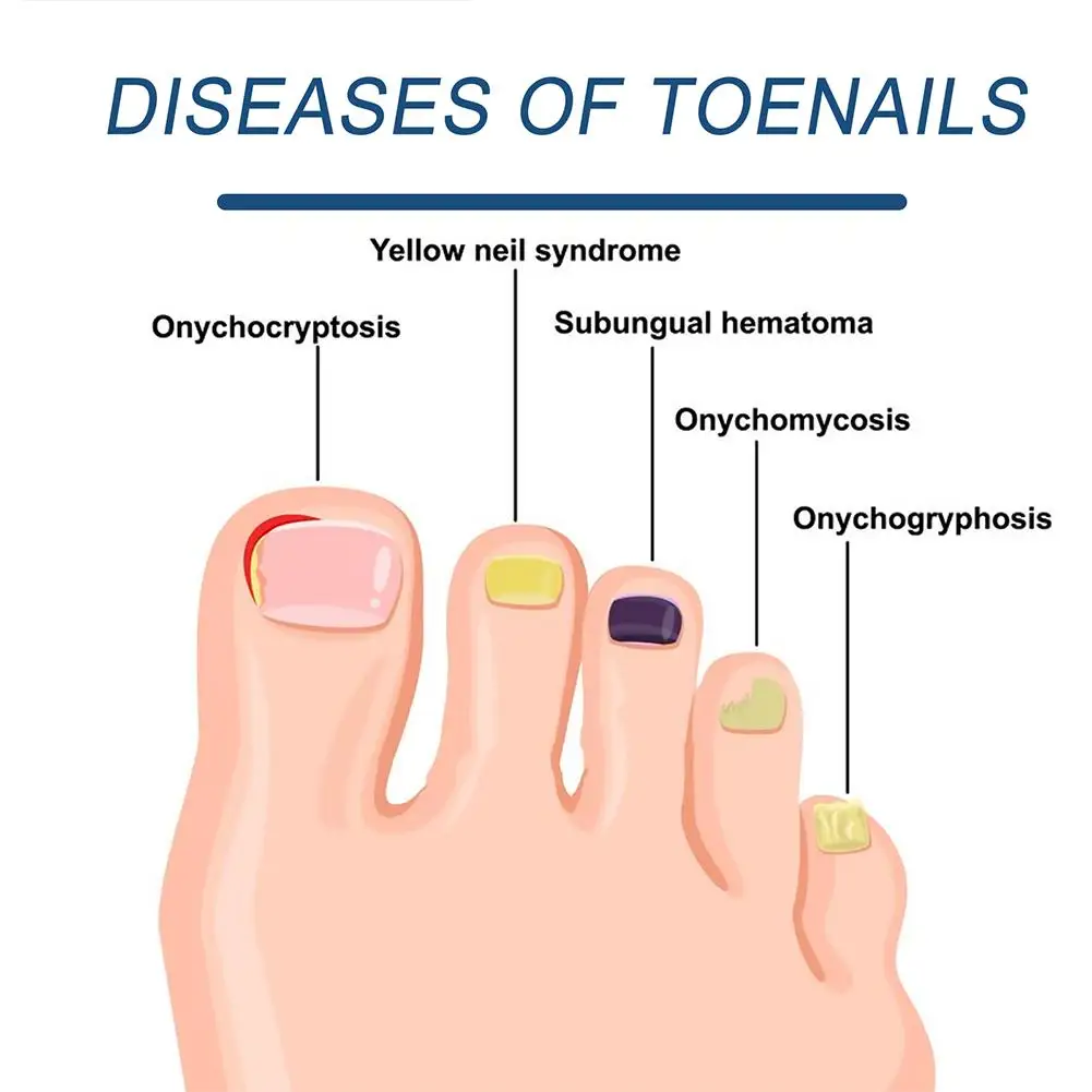 Fungal Nail Laser Device Repair Fast Nails Fungus Onychomycosis Nail Fungus Cleaning Laser Device Foot Health Care