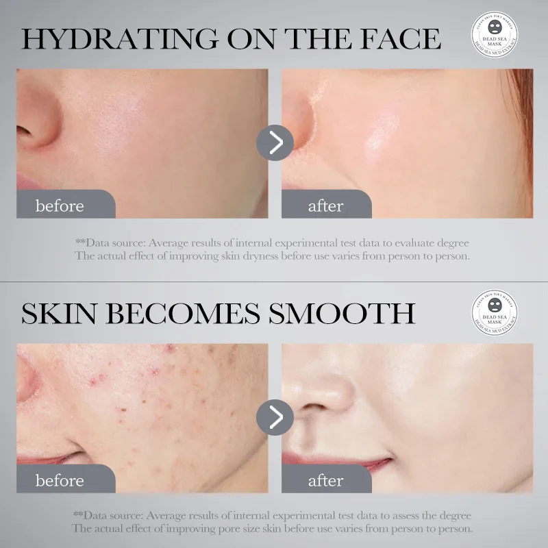 มาส์กโคลนทะเลเดดซี 10 ชิ้น 2025 - ทรีทเมนต์บำรุงผิวหน้าให้กระจ่างใส แพ็คเกจแบบธรรมดา