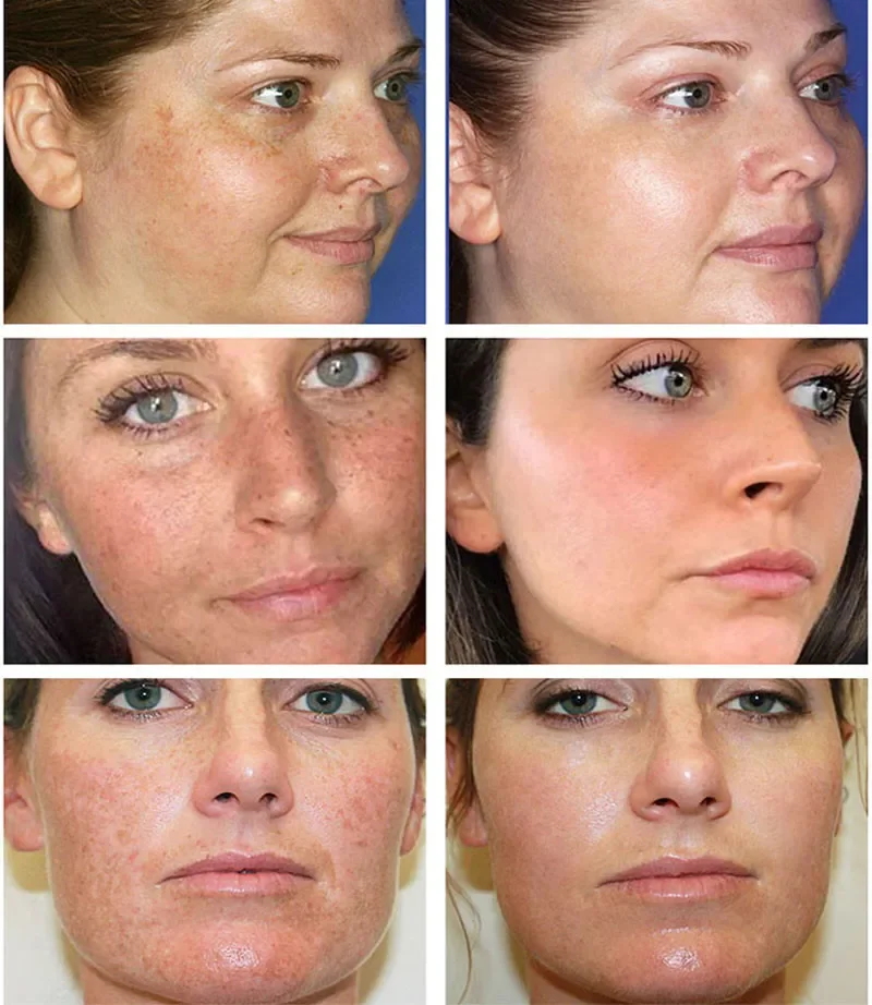 Krim Pemutih Penghilang Titik Kuat Mencerahkan Kulit dengan Cepat Menghilangkan Pigmentasi Melanin Melasma Bintik Hitam Melembabkan Gel Kecantikan