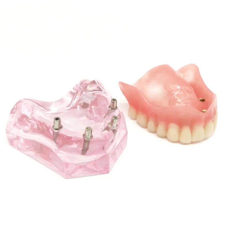 Dental Oral Teaching Denture Implant and Restoration Model Upper Half Mouth