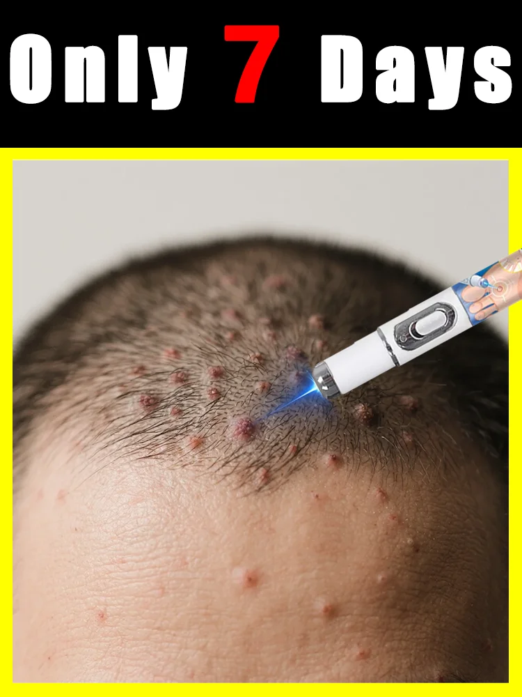 

2025 New,blue light pen solve warts,hotsale wart care tools,painless,free shipping