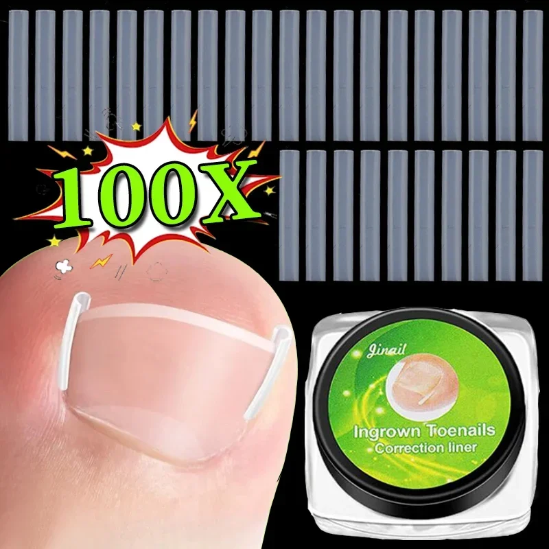 Ingrown Toenail Correction Tool 10BOX/100PCS Ingrown Nail Treatment Elastic Patch Sticker Straightening Clip Brace Pedicure Tool