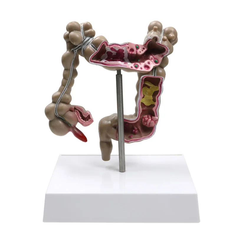 GREATLH Human Colorectal Lesion Model Gastrointestinal Anatomical Model Medical Organizer Anatomy