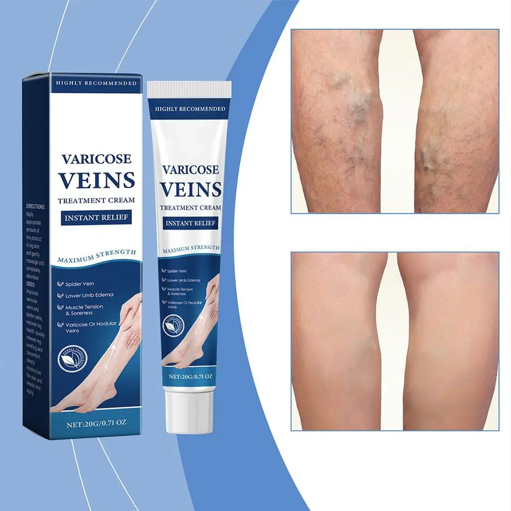 Spider Blood Varicose Veins Effective Varicose Vein Relief Cream To Relieve Vasculitis Phlebitis Spider Pain Treatment N EWW