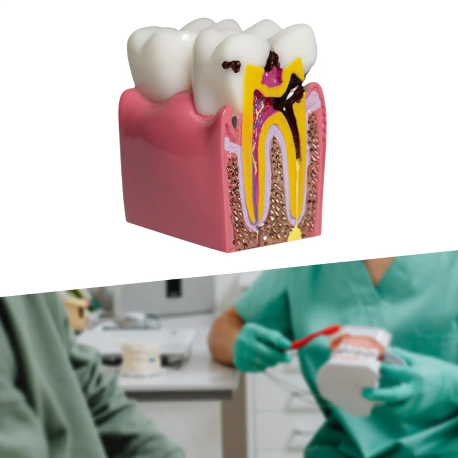 6 Times Caries Tooth Model Resin Caries Structure Detailed Teaching Aid Decay Tooth Comparative Study Model for Students Kids