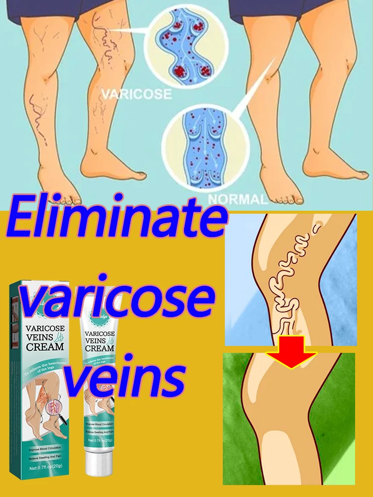 varices