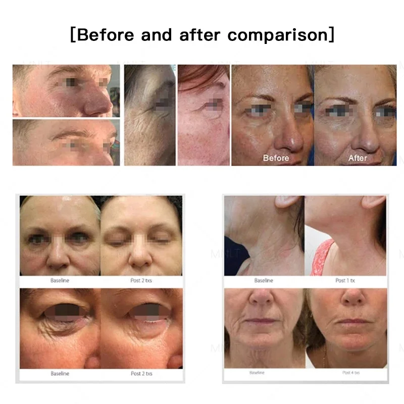 Hot Cold Plasma Beauty Machine For Anti-Aging Wrinkle Freckle Removal Therapy For Head Feet Armpit US/It Plug Desktop Equipment