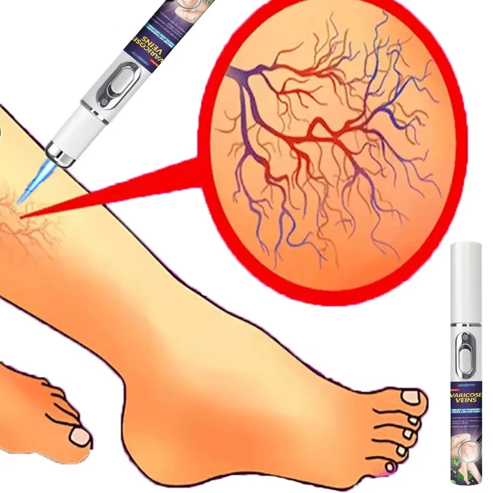 레이저 치료 다리 복구 펜, 최고의 선택은 페이스트와 펜입니다