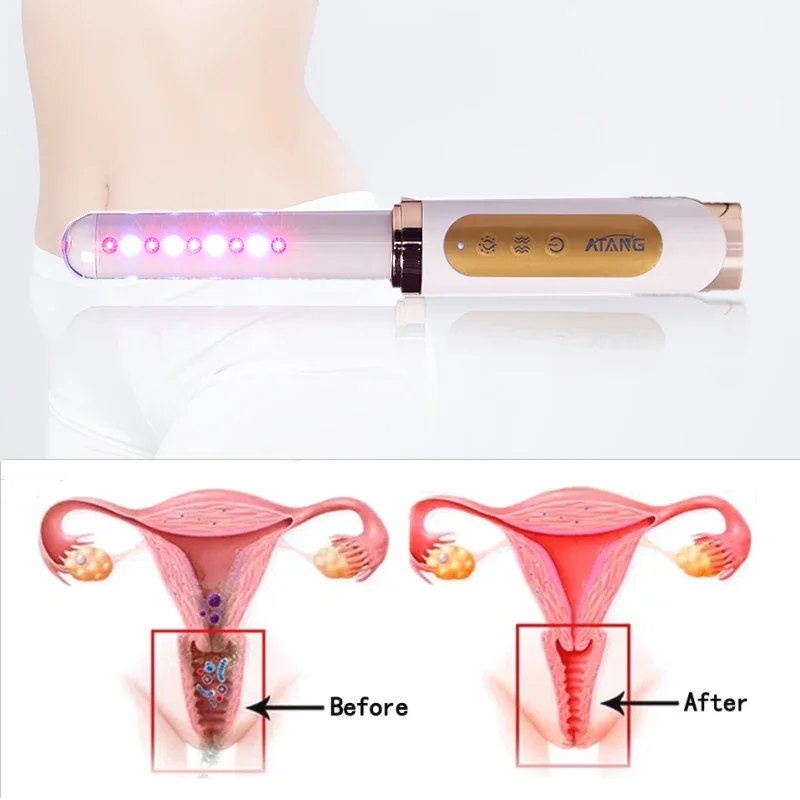 Vaginal wand  female health care  product for Vaginitis/Detox/eliminate odors and pruritus cold laser vaginal device