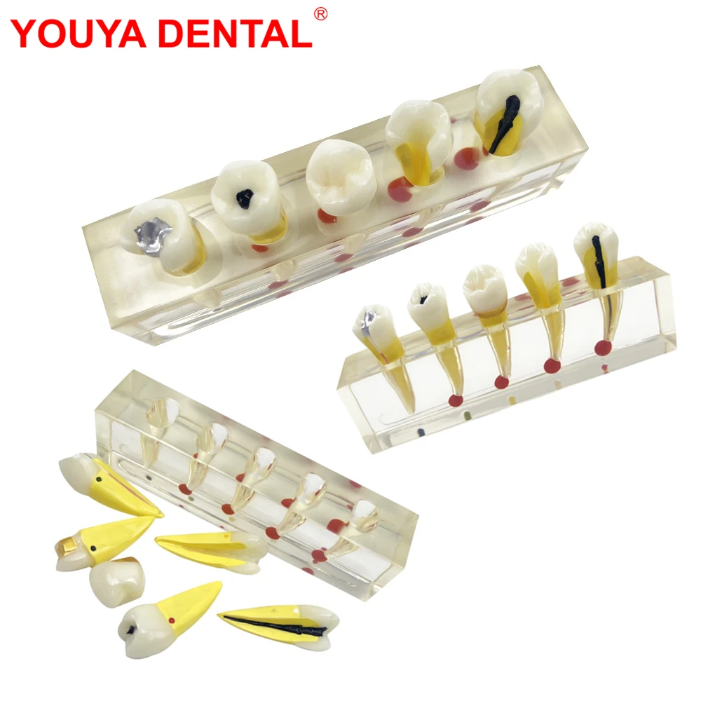 Dental Endodontic Clinical Model Transparent Caries Disease Anatomical Teeth Model For Studying Teaching Education Demonstration