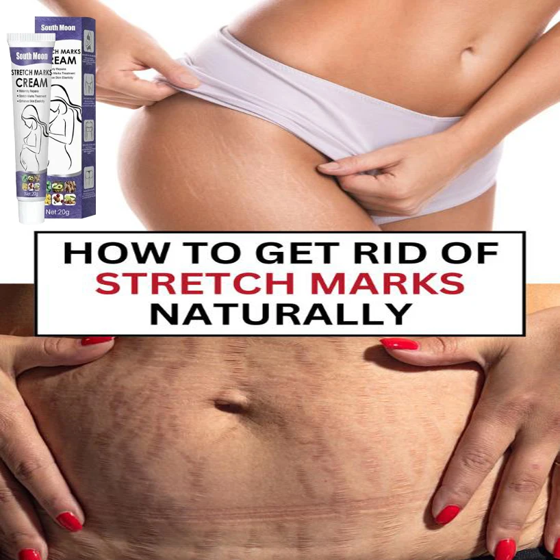 

HOT SALE Stretch Mark Cream Anti-wrinkle Anti-aging Maternal Skin Repair Remove Pregnancy Scar Treatment Body Skin Care