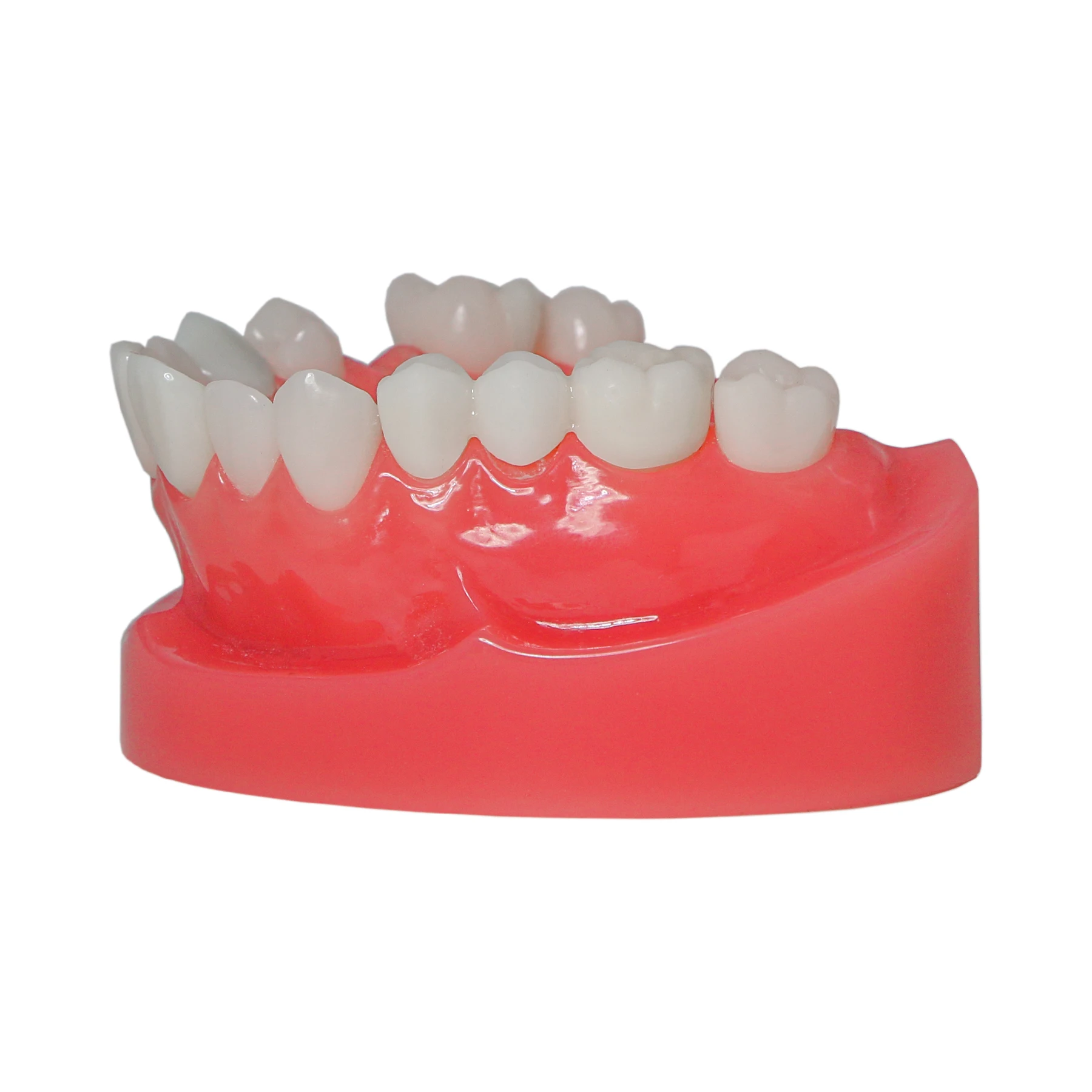 Afbeelding 5: M6024 Dental Post Core Bridge Overdenture Model Implantaatrestauratiemodel