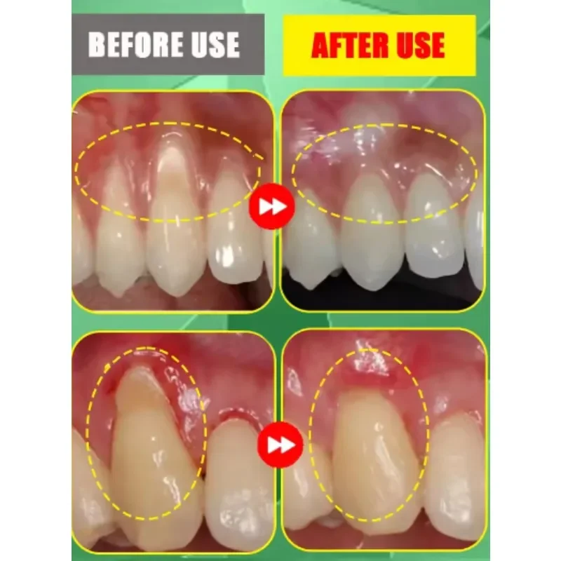 Гель для терапии десен Гель для терапии десен от зубов, отбеливание зубов, лечение неприятных десен, защита дыхания полости рта, гель для восстановления