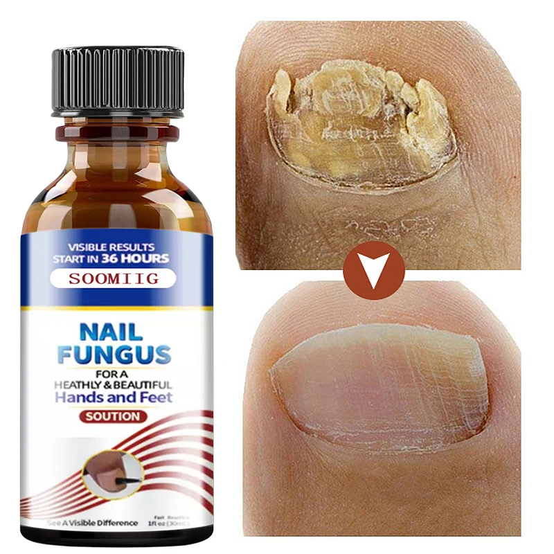 

30ml Nail Treatment essence Kits Fungus Removal repair Gel Anti Infection Paronychia Onychomycosis Serum Nourish Hand Foot Care