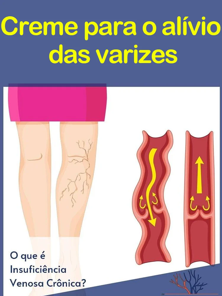 

Pomada para veias varicosas alivia eficazmente as veias varicosas e alivia vasculite e flebite