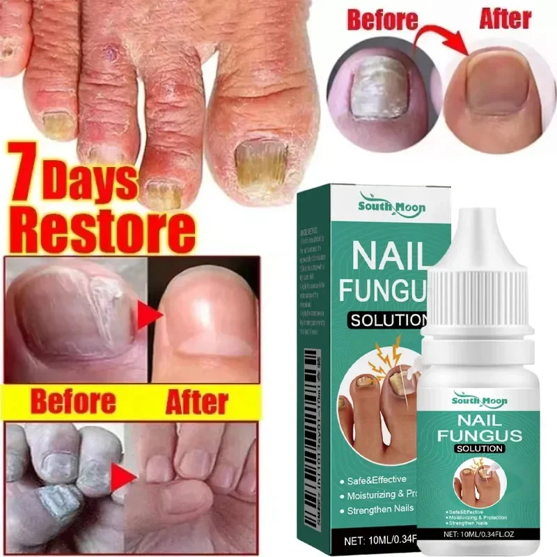 Fungal Nail Treatment Essence Oil Nail Fungus Laser Device Repair Toenail Fingernail Ginger Treatment Hand Foot Essence Liquid