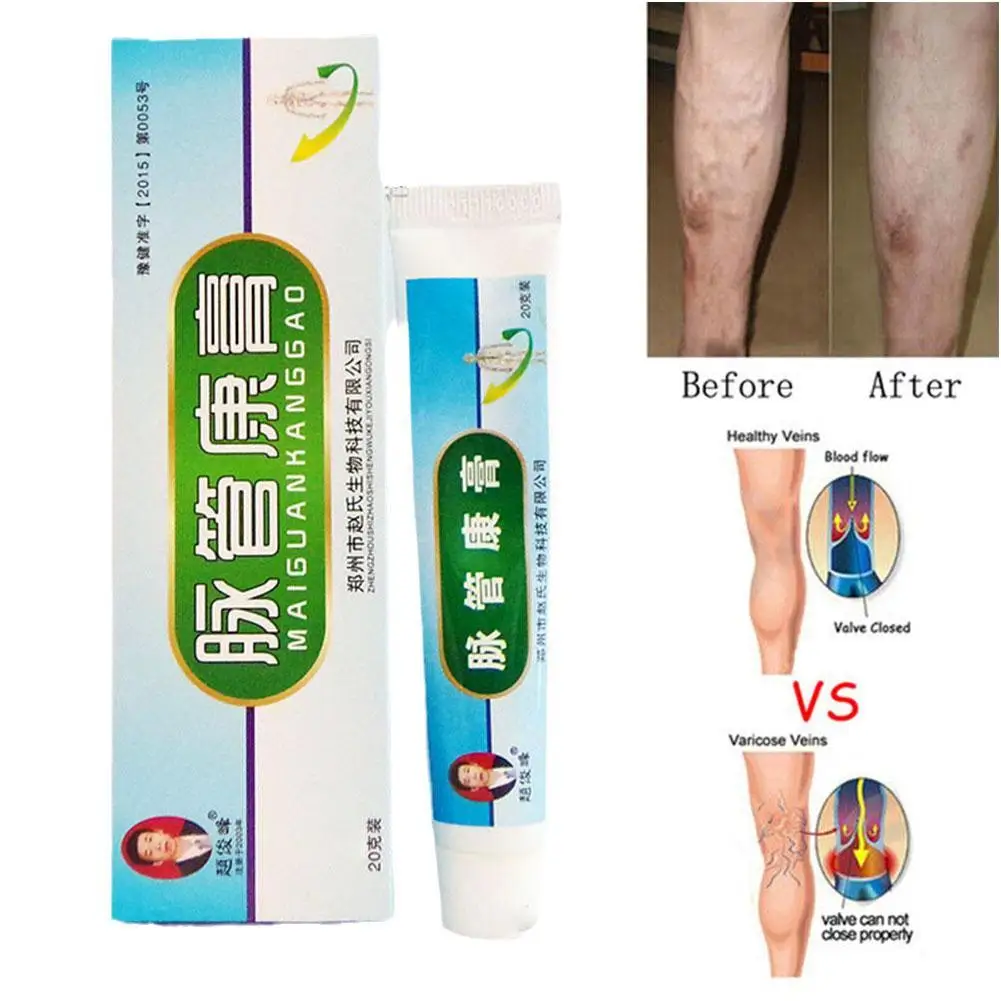 

Maiguankang Varicose Veins Treat Cream Varicosity Angiitis Remedy Ointment Relief Veins Pain Phlebitis Legs Varicose Veins Cream