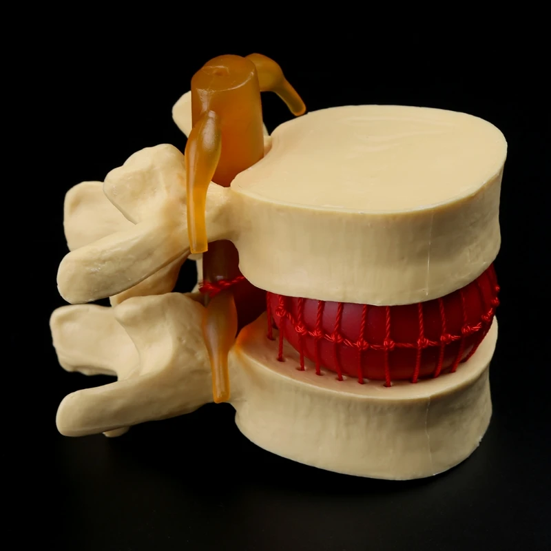 Modelo de enseñanza de hernia Lumbar, Anatomía Humana, esqueleto, columna vertebral, vértebra, modelo de demostración de Patología