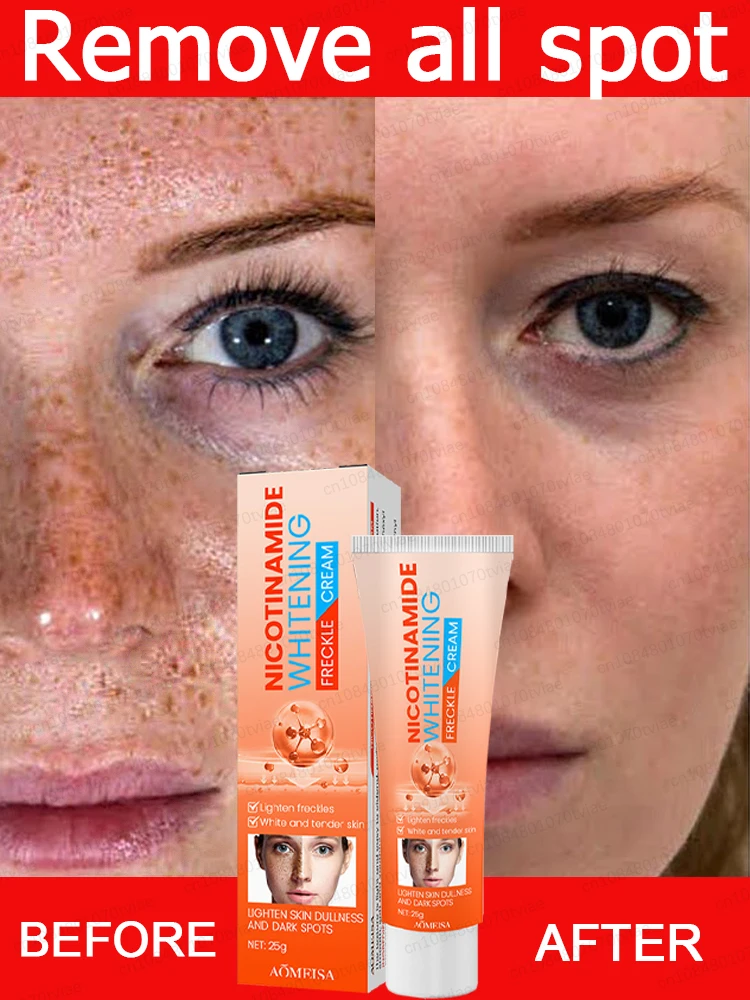 Face dark spot removal, anti-freckle cream, stretch mark cream, chloasma cream, age spot cream