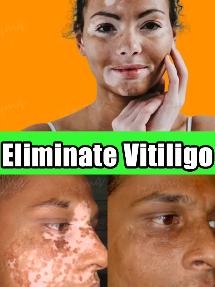 

Vitiligo Cream White Spot Fast Melanin Growth