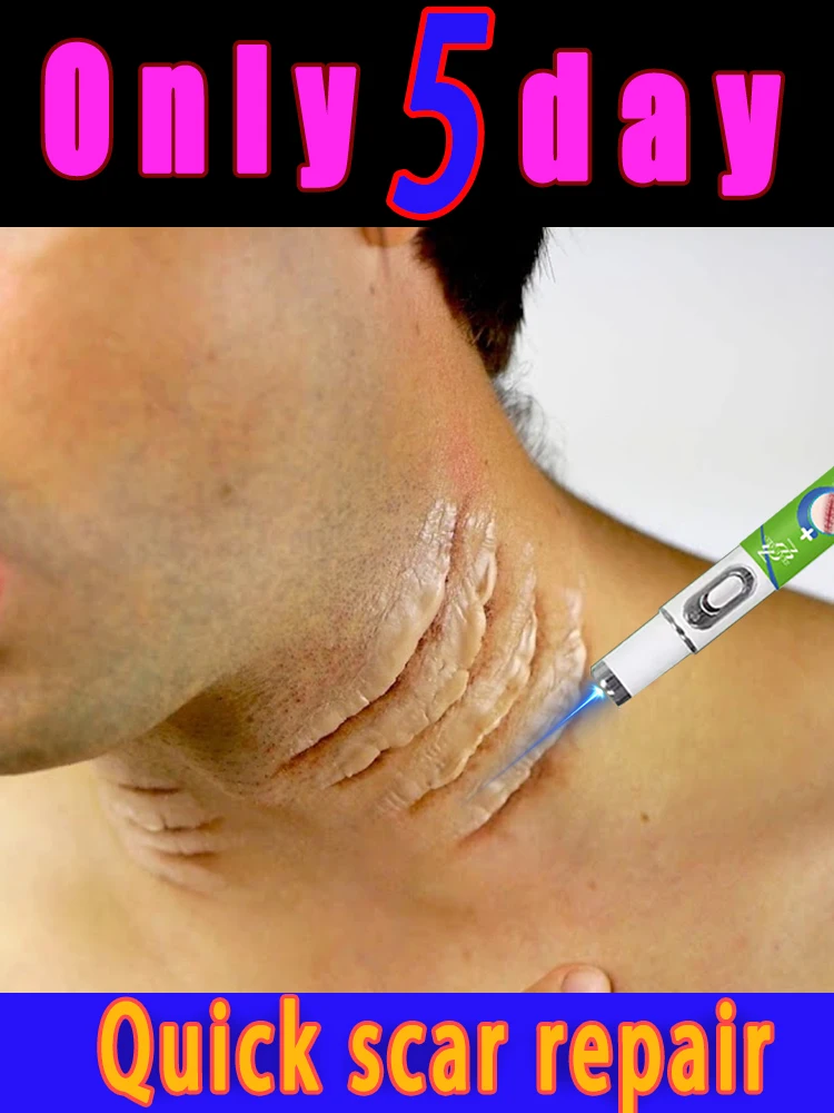 

Sᴄᴀʀ ʀᴇᴍᴏᴠᴀʟ ʟᴀsᴇʀ ᴘᴇɴ, sᴜɪᴛᴀʙʟᴇ ғᴏʀ ʀᴇᴍᴏᴠɪɴɢ ᴠᴀʀɪᴏᴜs sᴄᴀʀs, sᴜᴄʜ ᴀs ʙᴜʀɴs, ᴀʙʀᴀsɪᴏɴs, ᴇᴛᴄ.