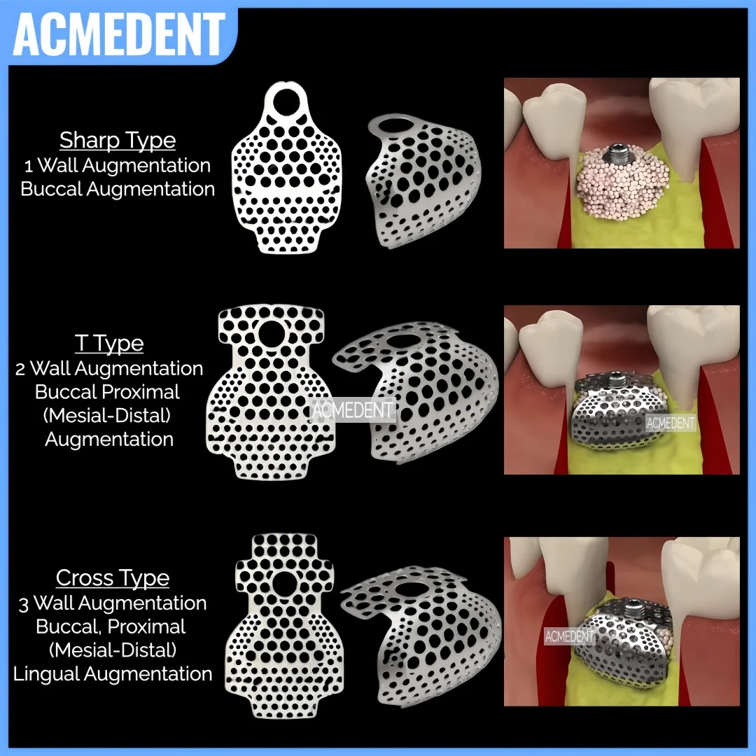 5Pc Dental OB2 GBR 3D Titanium Mesh Guided Bone Regeneration Membrane Plate Implant Bone Formation Bone Incremental SmartBuilder