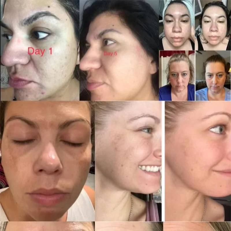 Creme Facial Hidratante, Remover Melasma Mancha Escura, Clareamento, Hidratante, Refirmante, Desbotamento, Sardas, Anti-envelhecimento, Skincare Produtos