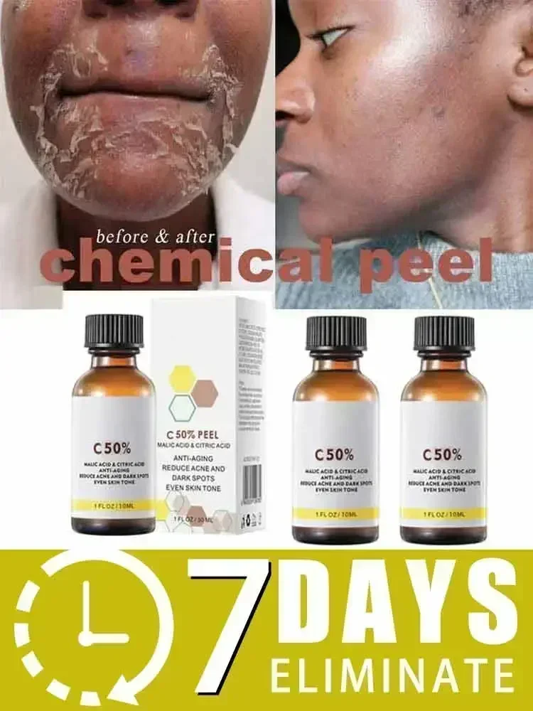 Peeling Oil for Dark Skin Spots, Remove Dead Skin, Lighten Melanin Scrub, Exfoliating, Brighten Moisturize, Facial Skin Care