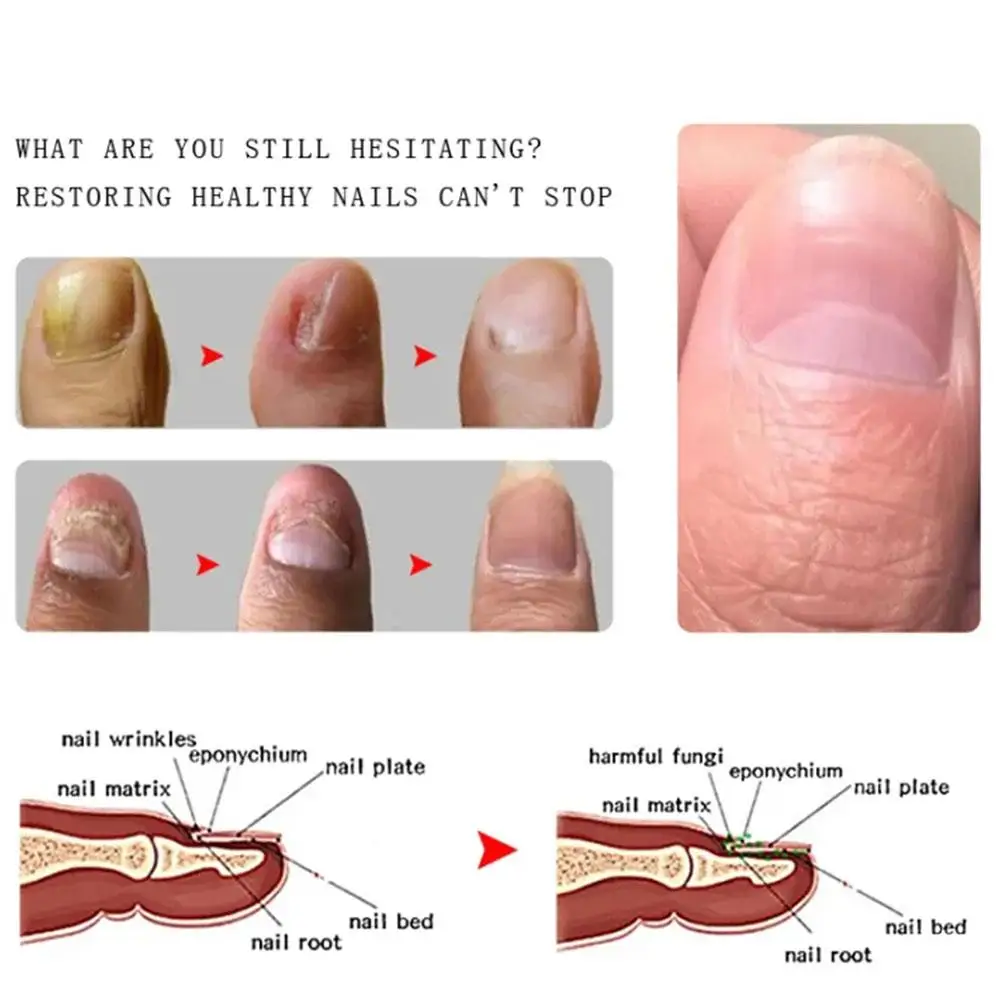 10ml Ingwer Nagel pflege lösung pflegt Nagels chicht fördert Wachstums reparatur beschädigte Schicht rau gebrochen schmerzlose Nagel gesundheits creme