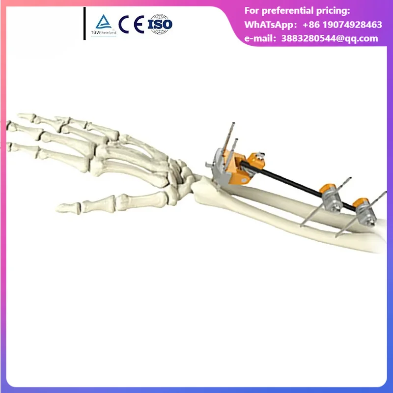 Hoffmann Type Orthopedic External Fixator, Ulna Radius Type For Ulna & Radius Fracture Fixation