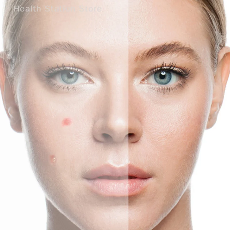 200 PCS สีสันน่ารักรูปดาวสิวสติกเกอร์ที่มองไม่เห็นสิวกําจัดสิว Patch Skin Care