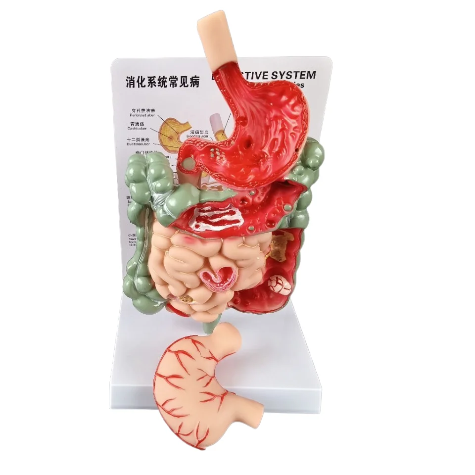 

Pathology Digestive system model Stomach section diagram Large intestine and small intestine anatomical model Medical demonstrat
