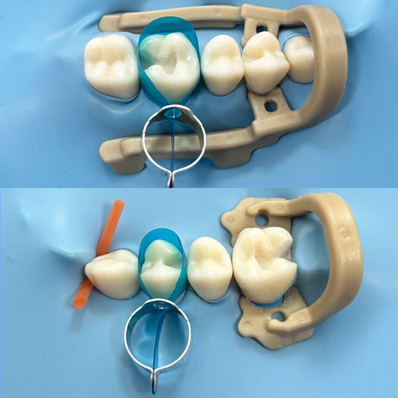 Vorgeformte Zahnmedizinische Retainer-Matrizenbänder Blau Transparent Posteriorer Matrizenstreifen Klasse-Ⅱ Restaurierungen Molarenring Zahnmedizin – Detail 4