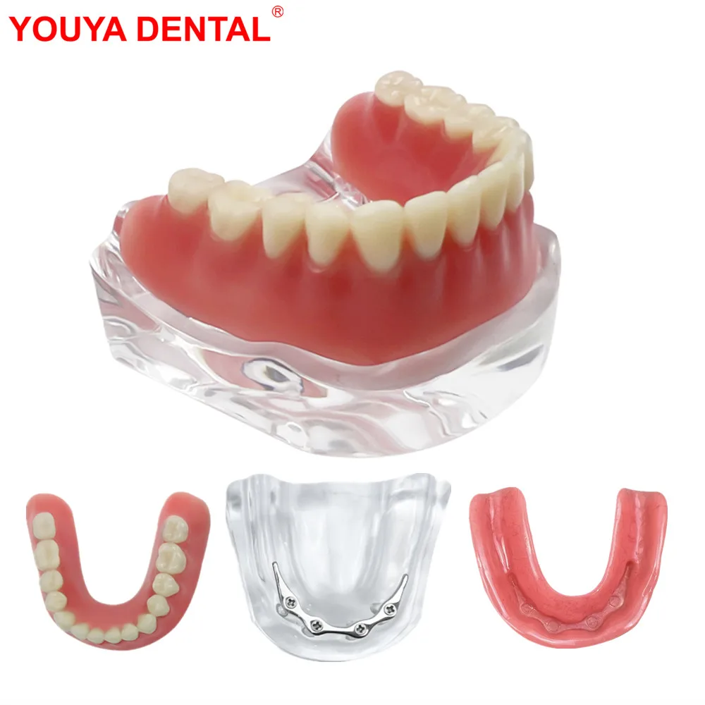 

Clear Dental Model Teeth Implant Restoration Bridge Removable Lower Overdenture Model For Teaching Studying Education Display