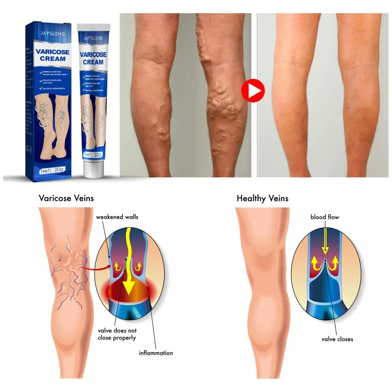 كريم تخفيف دوالي الوريد ، القضاء على التهاب الأوعية الدموية ، التهاب الوريد ، العنكبوت ، علاج الساقين ، مهدئ ، تخفيف الدم ، الأوعية الموضعية