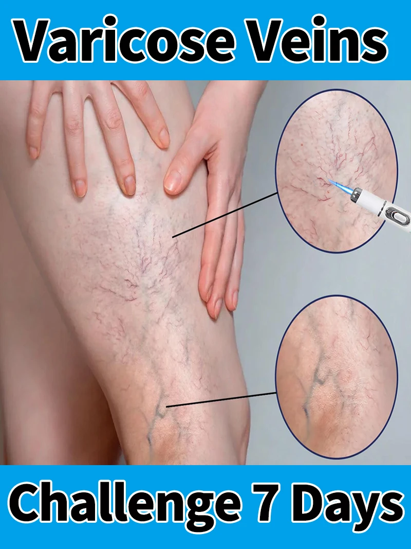 

Leg care tools, blue light pen, varicose veins, hot sale in 2025