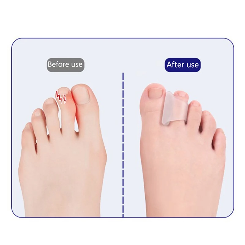 Separador Toe Silicone macio, pé sobreposição corrector, anti-desgaste cuidados almofadas, ferramentas de pedicure, tratar Hallux, Valgus, joanete, 1 par