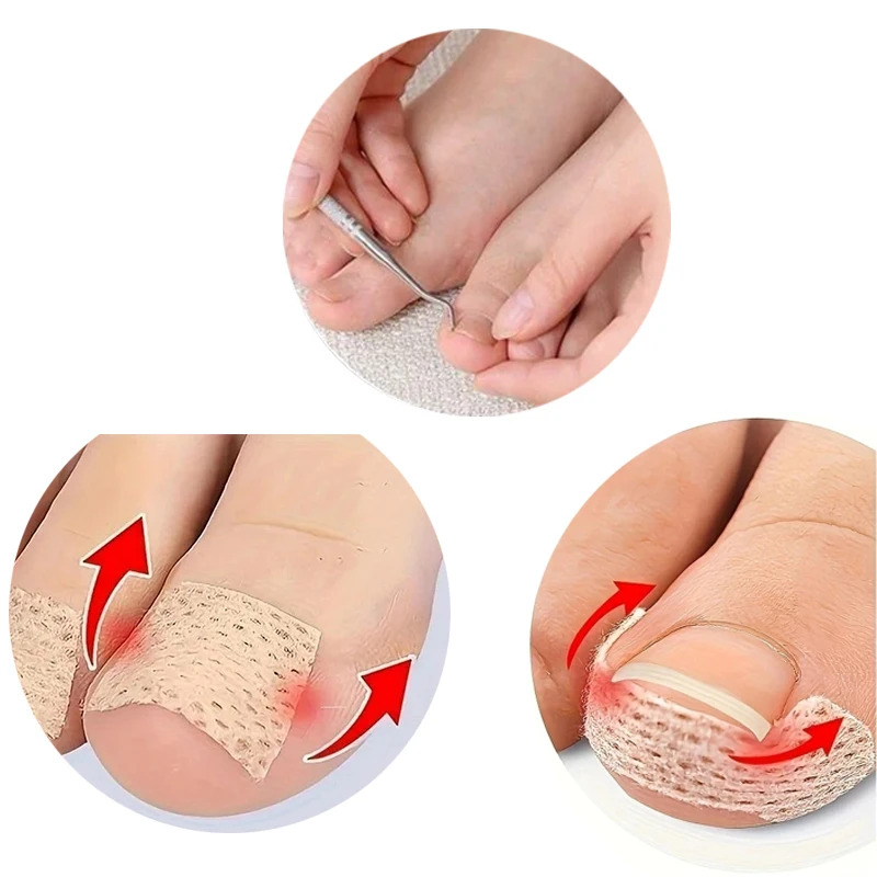 Toe Nail Correction Patch Nail Recover Toe Care Tool Nail Tool Correction Pedicure Tool Set