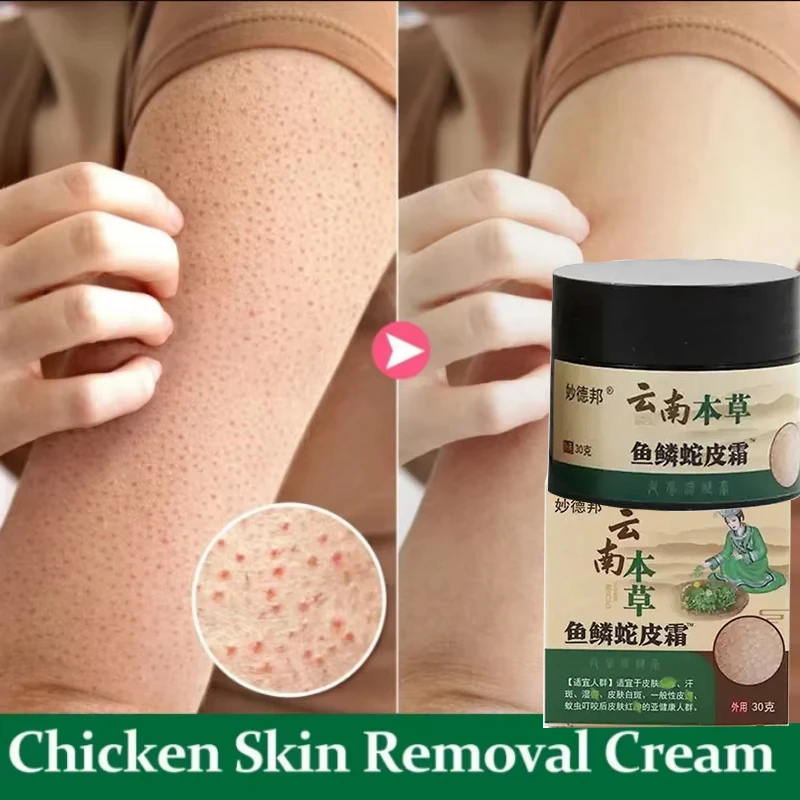 

Chicken Skin Repair Cream Curing Keratosis Follicle Pilaris Body Dark Spot Remove Thick Pores Moisturizing Smooth Essence